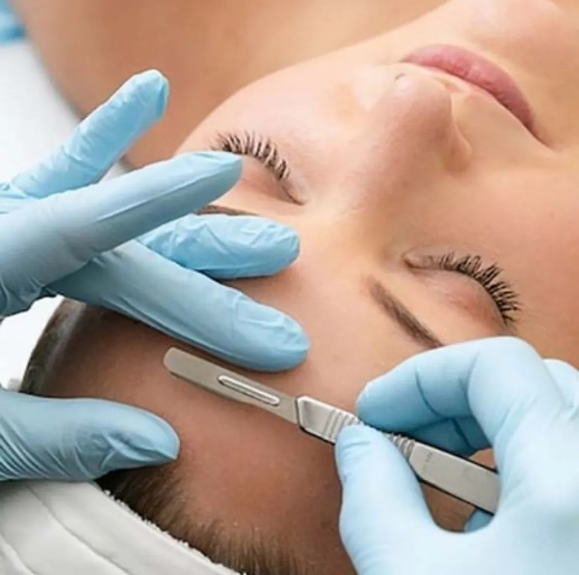 Professional dermaplaning treatment at Skin Deep Aesthetics in Halifax