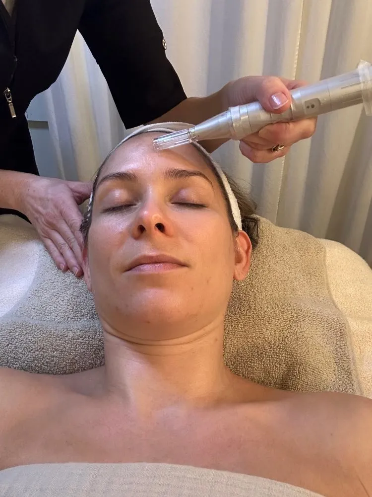 Microneedling treatment in progress at Skin Deep Aesthetics Halifax